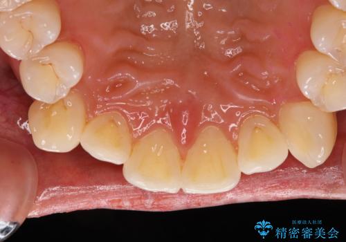 染め出しをしてエアフローで綺麗にクリーニングの症例 治療後
