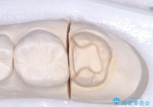 【セラミックインレー】口の中から金属を無くしたいの治療中