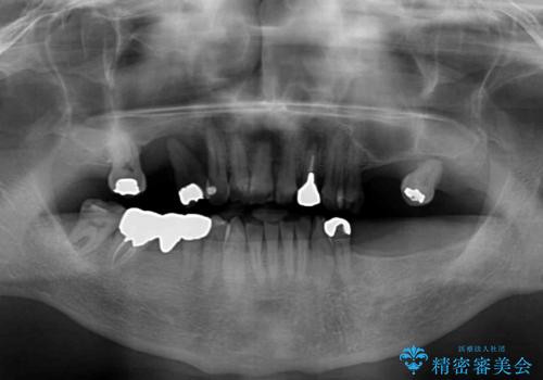 欠損の多い奥歯 インプラントによる補綴治療の治療前