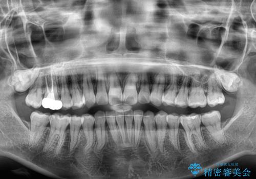 マウスピースが面倒くさい インビザラインでできるところまで頑張った矯正治療の治療後