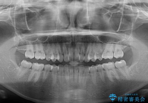 補助装置を併用して確実に インビザラインで奥歯の咬み合わせをしっかりと改善の治療前