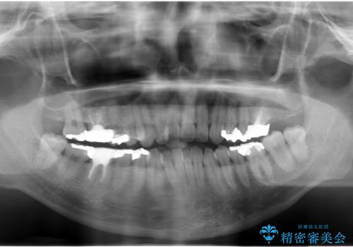 矯正と虫歯のセラミック治療 総合歯科治療の実践の治療前