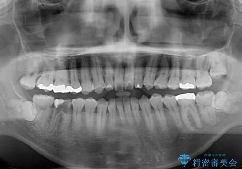 口元の突出感を改善!目立ちにくいワイヤー矯正で自信を持てる自然な横顔にの治療前