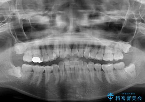 マウスピースが面倒くさい インビザラインでできるところまで頑張った矯正治療の治療前