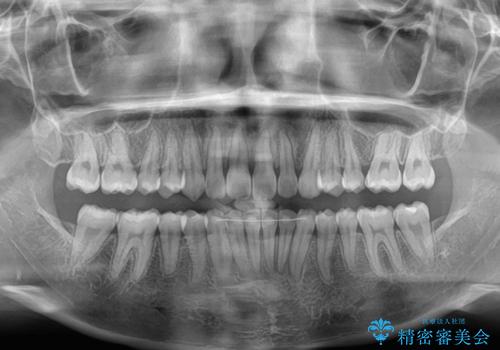 補助装置を併用して確実に インビザラインで奥歯の咬み合わせをしっかりと改善の治療後