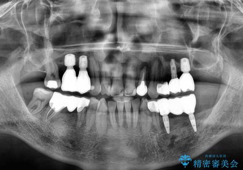 欠損の多い奥歯　インプラントによる補綴治療の治療後