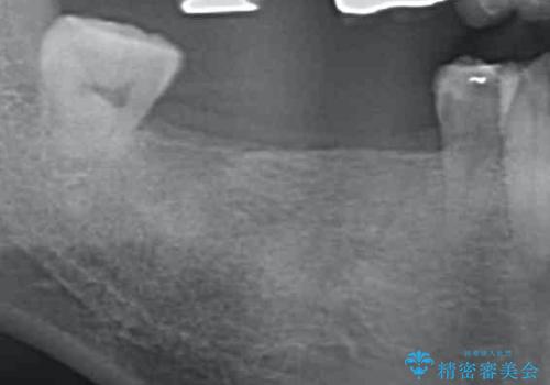 失った奥歯をインプラントで機能回復の治療前