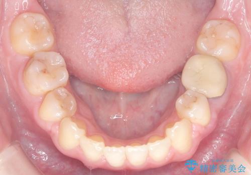 歯のデコボコ|口ボコ|八重歯が気になる!|ワイヤー矯正の治療後