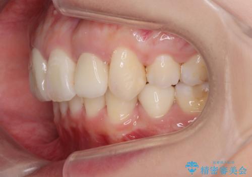 がたつきと出っ歯 ワイヤー矯正での歯並び改善の治療後