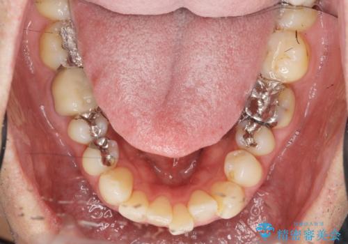 矯正と虫歯のセラミック治療 総合歯科治療の実践の治療前