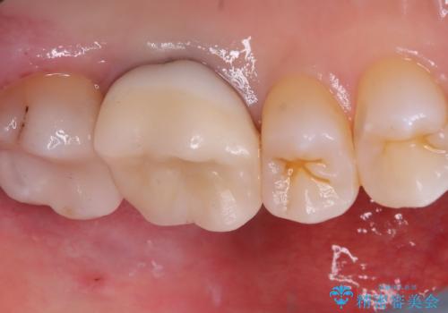 【セラミックインレー】口の中から金属を無くしたいの治療後