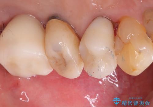 【インプラント】噛んだら痛みがあるの治療後