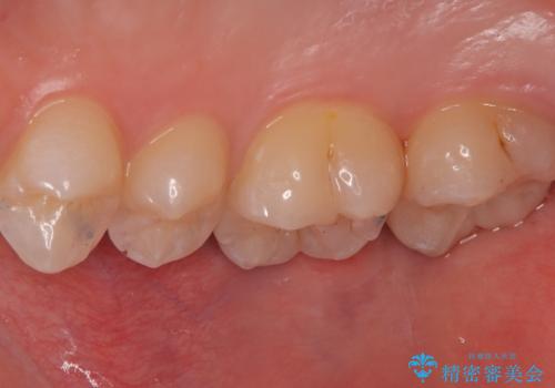 【セラミックインレー】歯科検診で虫歯が見つかったの治療後