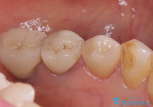 【セラミッククラウン】知覚過敏をどうにかしてほしいの治療後