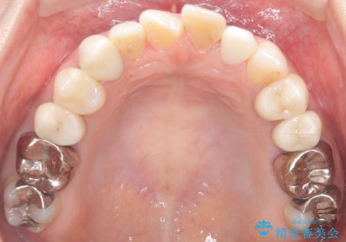 【セラミッククラウン】歯の根元が欠けた、歯が揺れている気がするの治療後