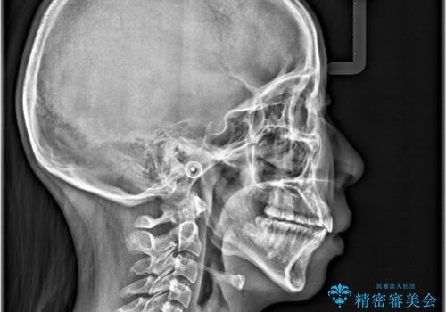 歯のデコボコを治したい! |インビザラインでわずか6ヵ月で矯正完了!の治療後