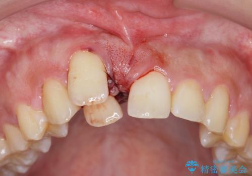 正中過剰埋伏歯で生じた前歯の審美障害 矯正治療での改善の治療前