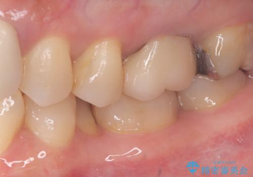 【セラミックインレー】口の中から金属を無くしたいの治療前