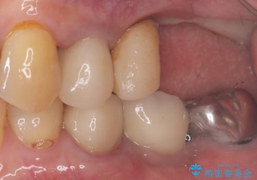 【インプラント】噛んだら痛みがあるの治療前