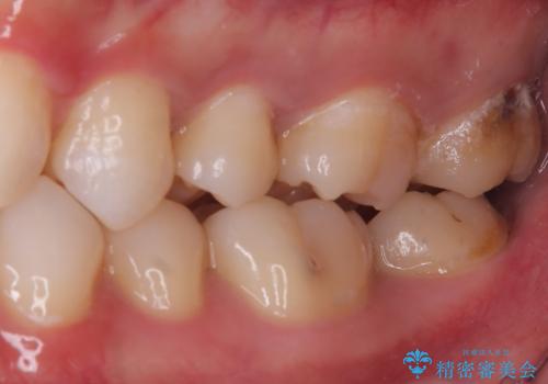 【セラミックインレー】歯科検診で虫歯が見つかったの治療前