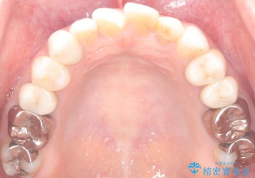 【セラミッククラウン】歯の根元が欠けた、歯が揺れている気がするの治療前