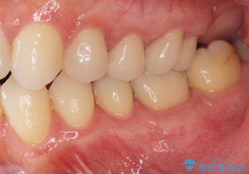 矯正と虫歯のセラミック治療 総合歯科治療の実践の治療後
