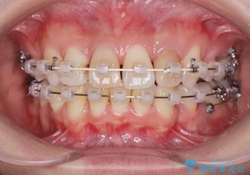 がたつきと出っ歯 ワイヤー矯正での歯並び改善の治療中