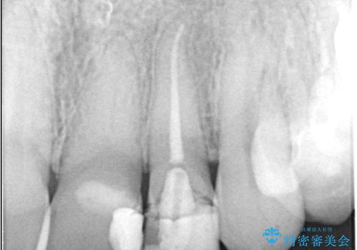 【セラミッククラウン】歯の根元が欠けた、歯が揺れている気がするの治療前