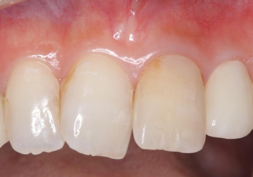 【セラミッククラウン】歯の根元が欠けた、歯が揺れている気がするの治療後