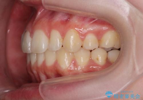 マウスピースで行う出っ歯の改善 後方移動の治療後