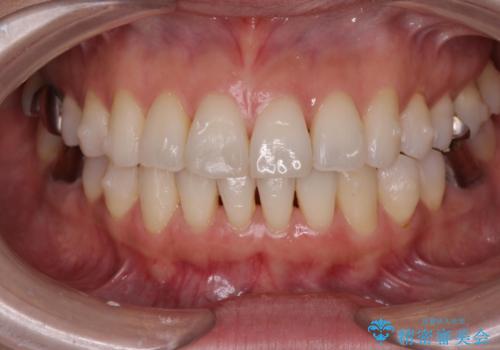 抜歯をせず前歯の角度を改善するマウスピース矯正治療の治療中