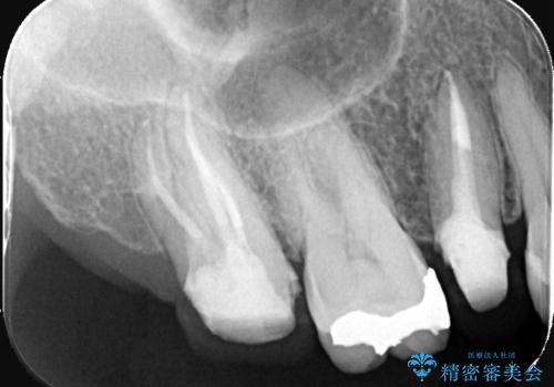奥歯の根の病変も精密治療で解決の治療中