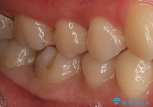 奥歯の虫歯を直したい セラミックインレーの治療前