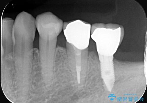 【セラミッククラウン】知覚過敏をどうにかしてほしいの治療前