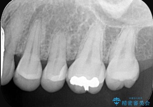 虫歯の治療 〈セラミックインレー〉の治療後