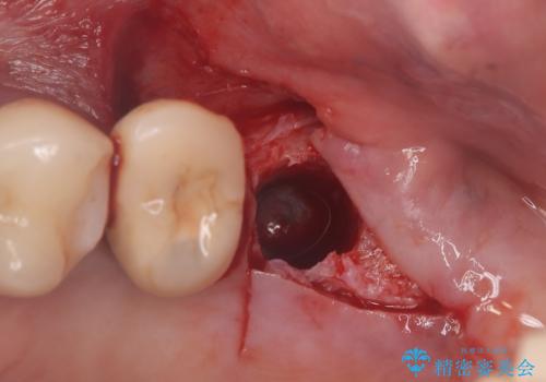 【インプラント】噛んだら痛みがあるの治療中