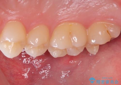 【セラミックインレー】歯科検診で虫歯が見つかったの治療中