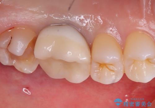 【セラミックインレー】口の中から金属を無くしたいの治療中
