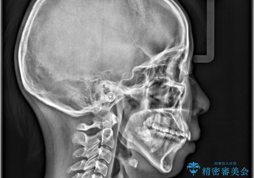 歯のデコボコを治したい! |インビザラインでわずか6ヵ月で矯正完了!の治療前