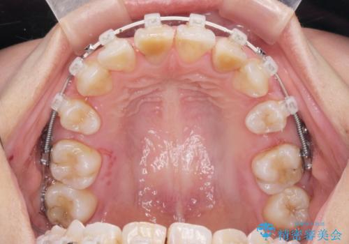 がたつきと出っ歯 ワイヤー矯正での歯並び改善の治療中