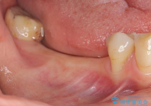 失った奥歯をインプラントで機能回復の症例 治療前