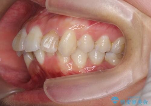 がたつきと出っ歯 ワイヤー矯正での歯並び改善の治療前