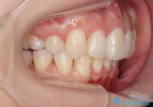 がたつきと出っ歯 ワイヤー矯正での歯並び改善の治療後