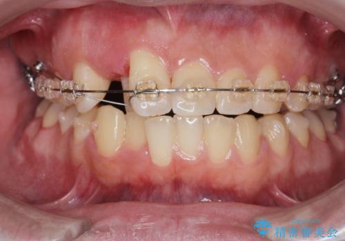 正中過剰埋伏歯で生じた前歯の審美障害 矯正治療での改善の治療中