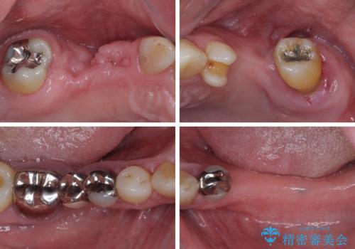 欠損の多い奥歯 インプラントによる補綴治療の治療前
