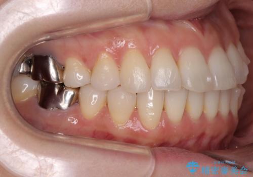 抜歯をせず前歯の角度を改善するマウスピース矯正治療の治療中