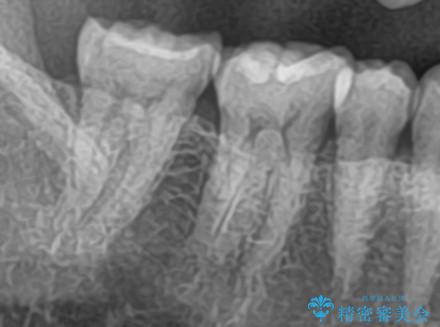 セラミッククラウンによる奥歯の修復の治療前