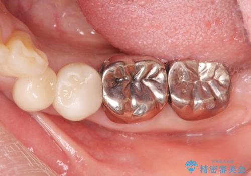 銀歯の除去 長期的な未来を見据えた虫歯治療の治療前