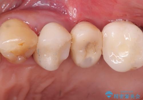 【インプラント】噛んだら痛みがあるの症例 治療後