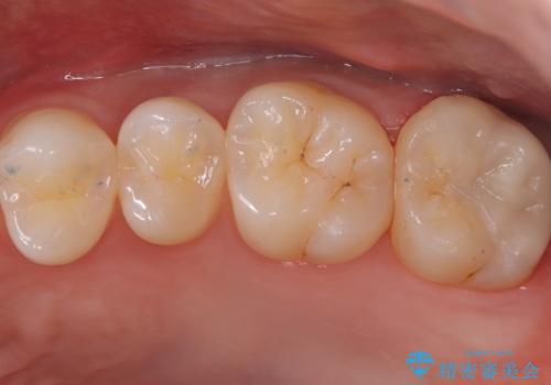 【セラミックインレー】歯科検診で虫歯が見つかったの症例 治療後